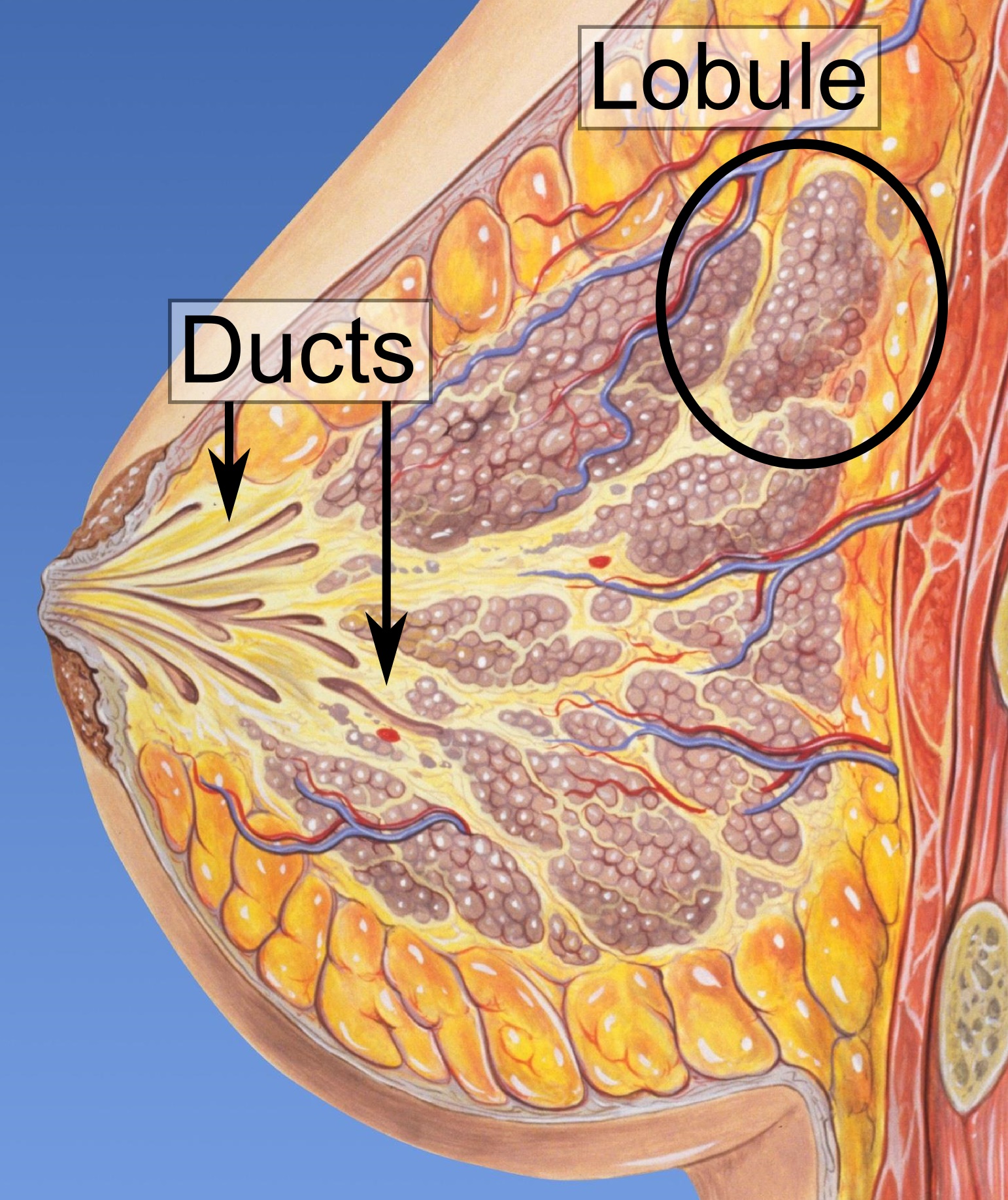 Ductal carcinoma in situ (DCIS)